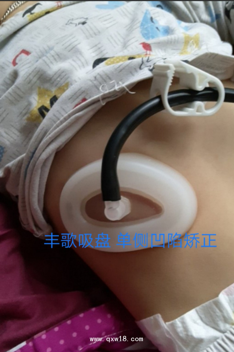 漏斗胸矯正器，負壓吸盤