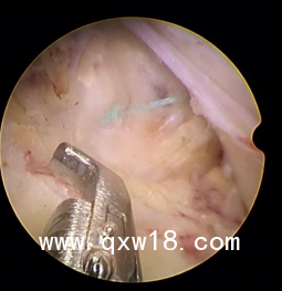 深圳骨科脊柱高值耗材一次性纖維環(huán)品牌廠家