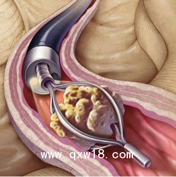 激光治療機 JRHI鈥激光 泌尿系統(tǒng)結(jié)石粉碎機 普美康