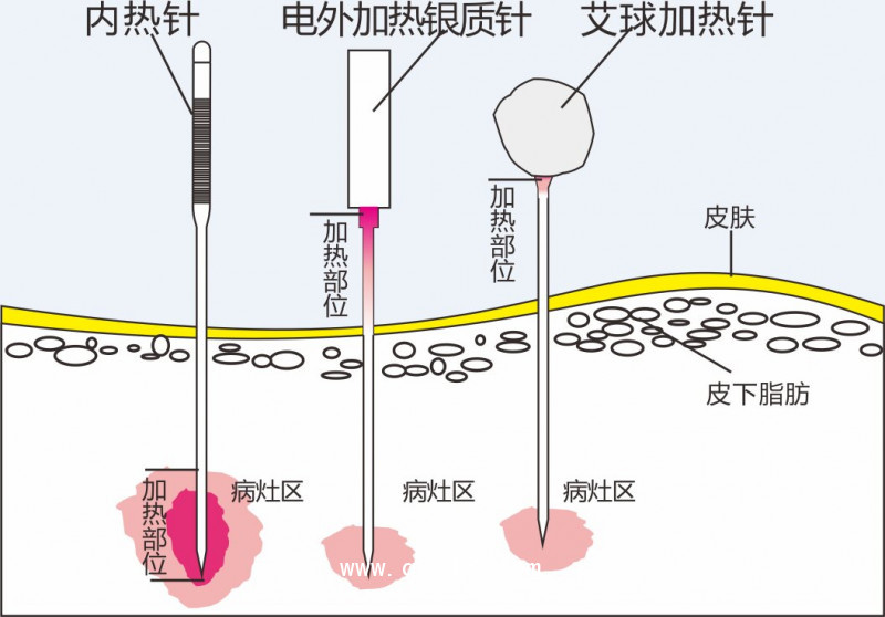 內熱針治療儀40路 50路全國招商
