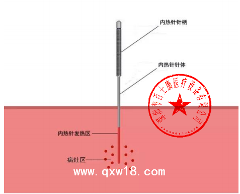 百士康生產廠家1.1mm*140mm 內熱針 內熱式針灸針