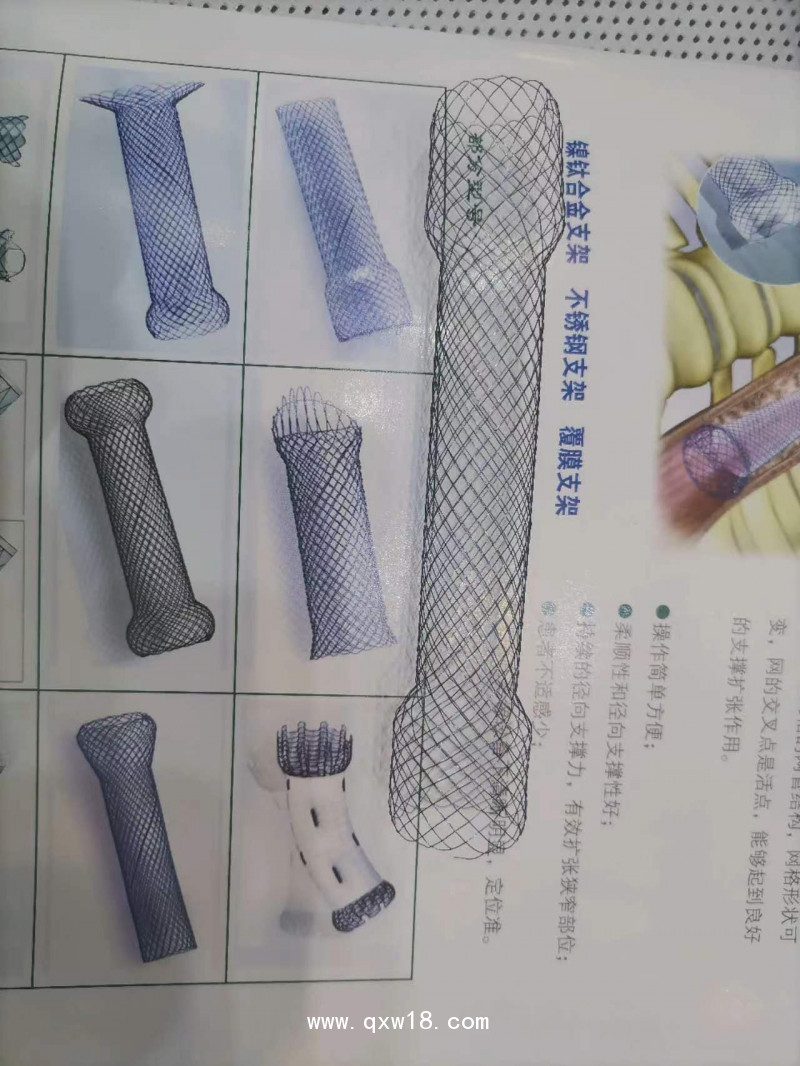 覆膜膽道支架、膽管