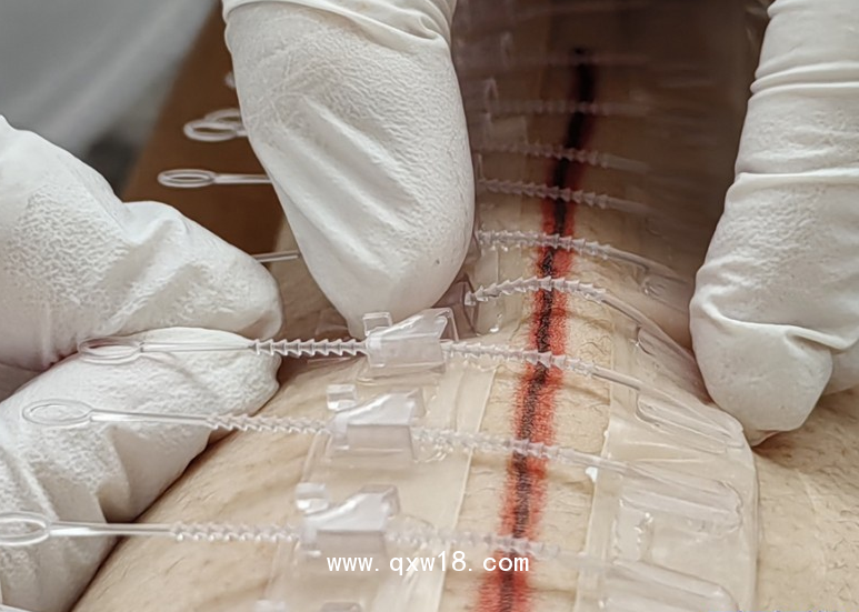 一次性皮膚縫合器/醫(yī)用無(wú)針縫合器/醫(yī)用免縫拉鏈/一次性皮膚吻合器/一次性皮膚減張器