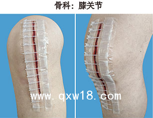 一次性皮膚縫合器/醫(yī)用無(wú)針縫合器/醫(yī)用免縫拉鏈/一次性皮膚吻合器/一次性皮膚減張器