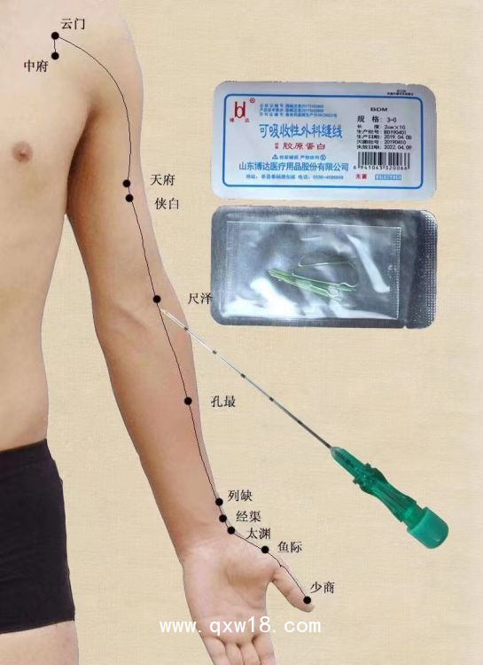 膠原蛋白穴位埋線