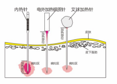 內(nèi)熱針針具、銀質(zhì)針設(shè)備 內(nèi)熱針治療儀