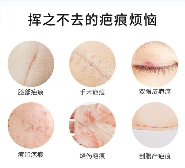 疤痕貼 疤痕凝膠生產(chǎn)廠家—全國招商承接代加工—可來樣加工按需定制