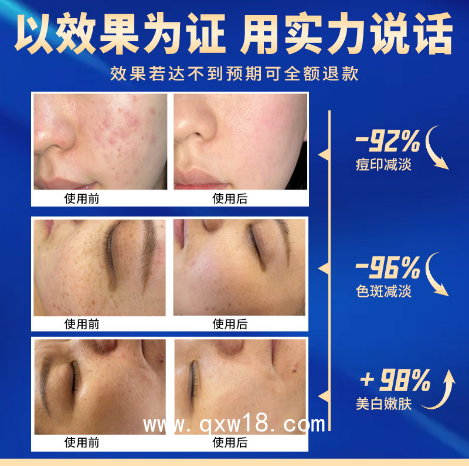 強(qiáng)脈沖光治療儀_光子嫩膚儀器美白嫩膚_醫(yī)療診所專用