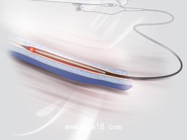 一次性使用靜脈腔內(nèi)射頻閉合導(dǎo)管