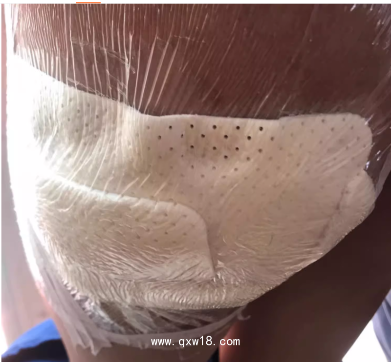 醫(yī)用透明敷貼20x30cm封閉負(fù)壓引流VSD 護(hù)創(chuàng)無(wú)菌敷貼膜vsd