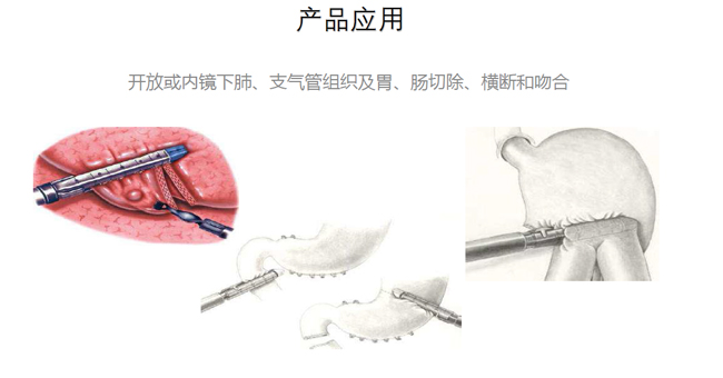 吻合器產(chǎn)品應用