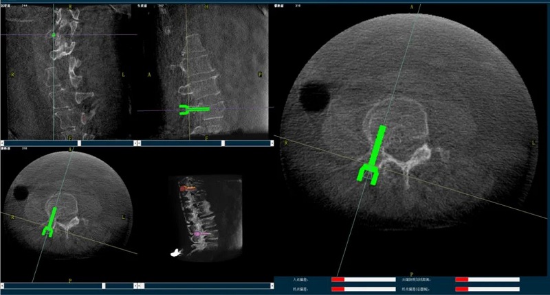 使用機器人做椎體成形術(shù)的過程1