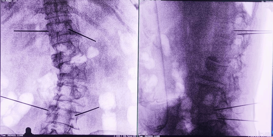 骨科手術機器人術后圖像