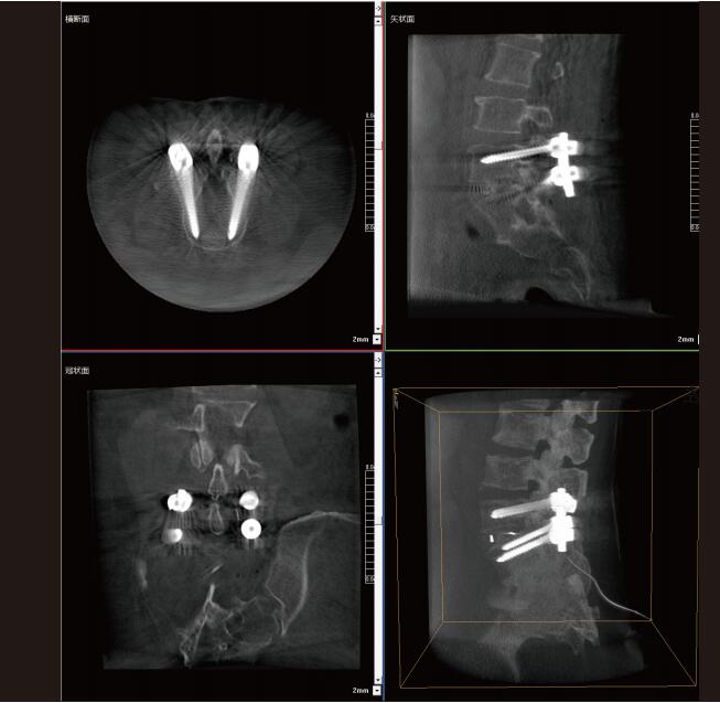 大功率移動式三維C形臂腰椎影像