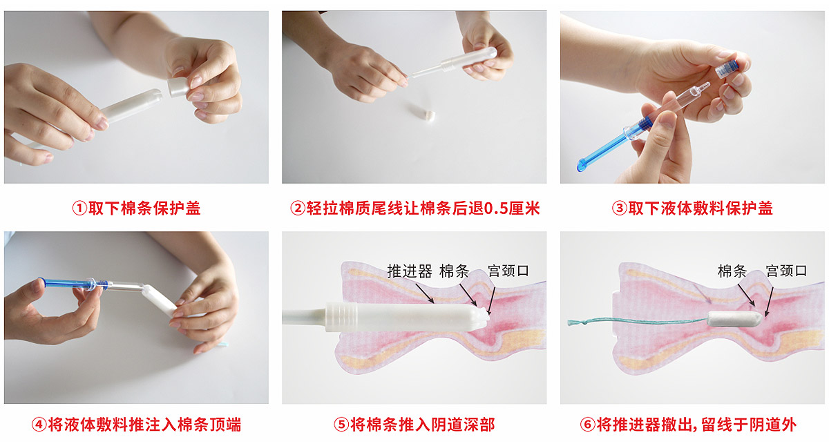 宮腔填塞吸附栓、陰道填塞吸附栓、陰道填塞止血吸附栓